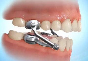 Andere beugels - Orthodontiepraktijk